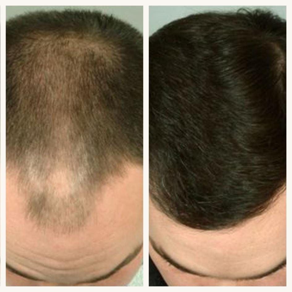 Hair Transplant - Before After 11