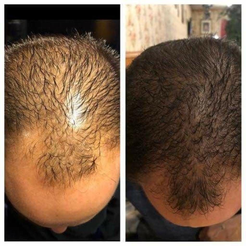 Hair Transplant - Before After 21