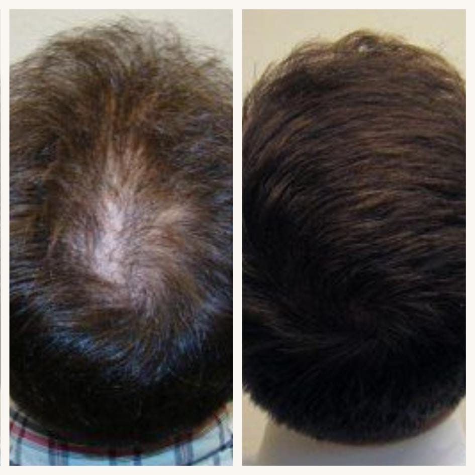 Hair Transplant - Before After 31