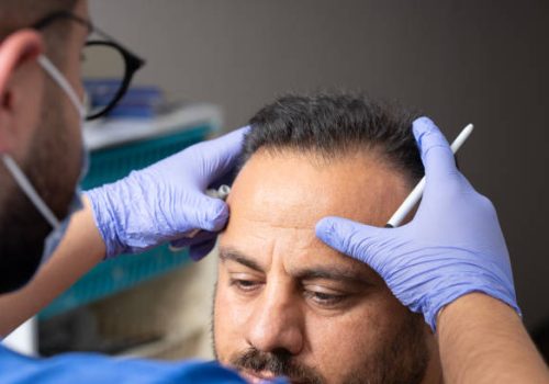 A doctor wearing blue gloves is holding the patient’s head and trying to identify the area for the hair transplant. The doctor has a pen in hand for making markings. This stage demonstrates the importance of planning and precision before the hair transplant procedure. The doctor’s careful work reflects meticulous preparation to achieve the best results. The image captures a critical moment in the pre-hair transplant preparation.