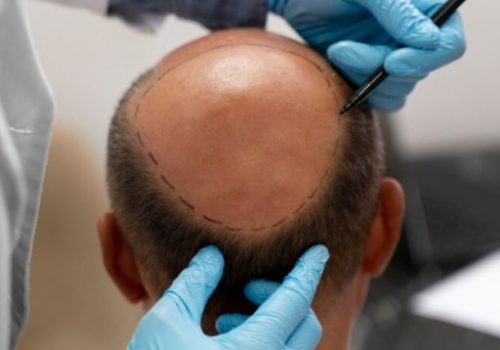 Hair Transplant Extraction