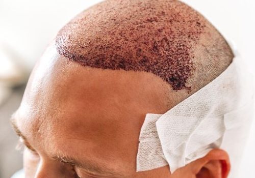 Hair Transplant Procedure